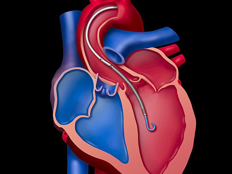 Impella at Sansum Clinic 2